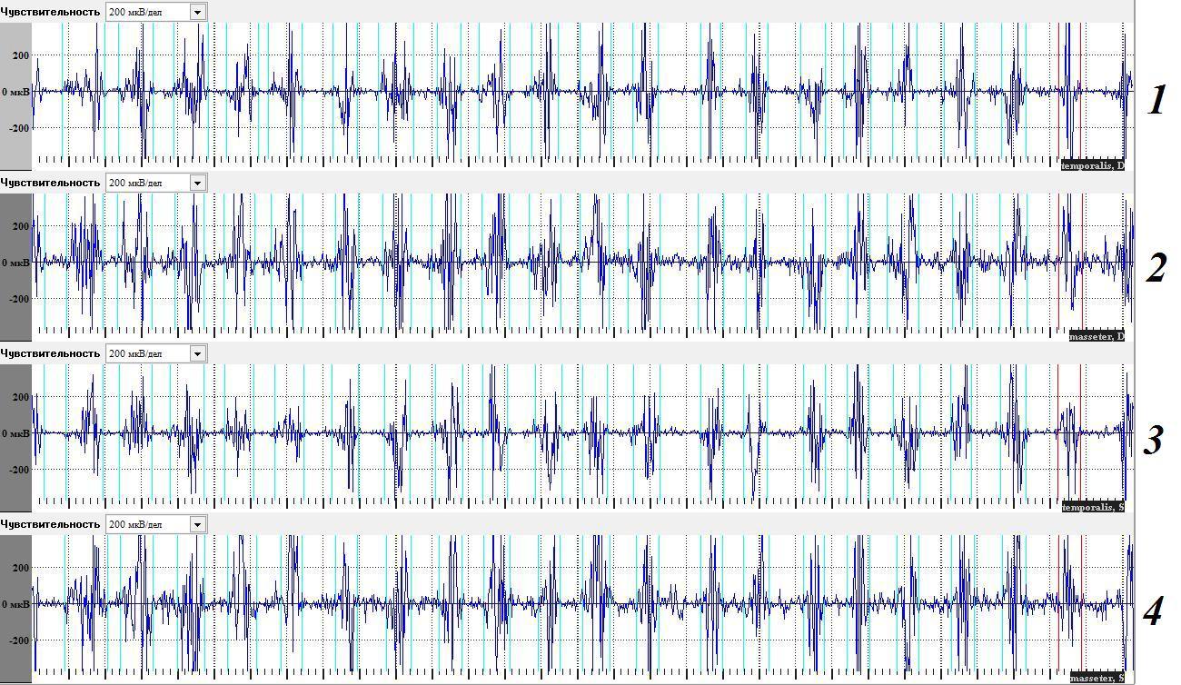 Рис. 2. Электромиограмма испытуемой Л., 45 лет при жевании 0,8 г сушеного миндаля в течение 15 с. 1-temporalis, D; 2-masseter, D; 3 - temporalis, S; 4-masseter, S. Чувствительность 200 мкВ/дел. 