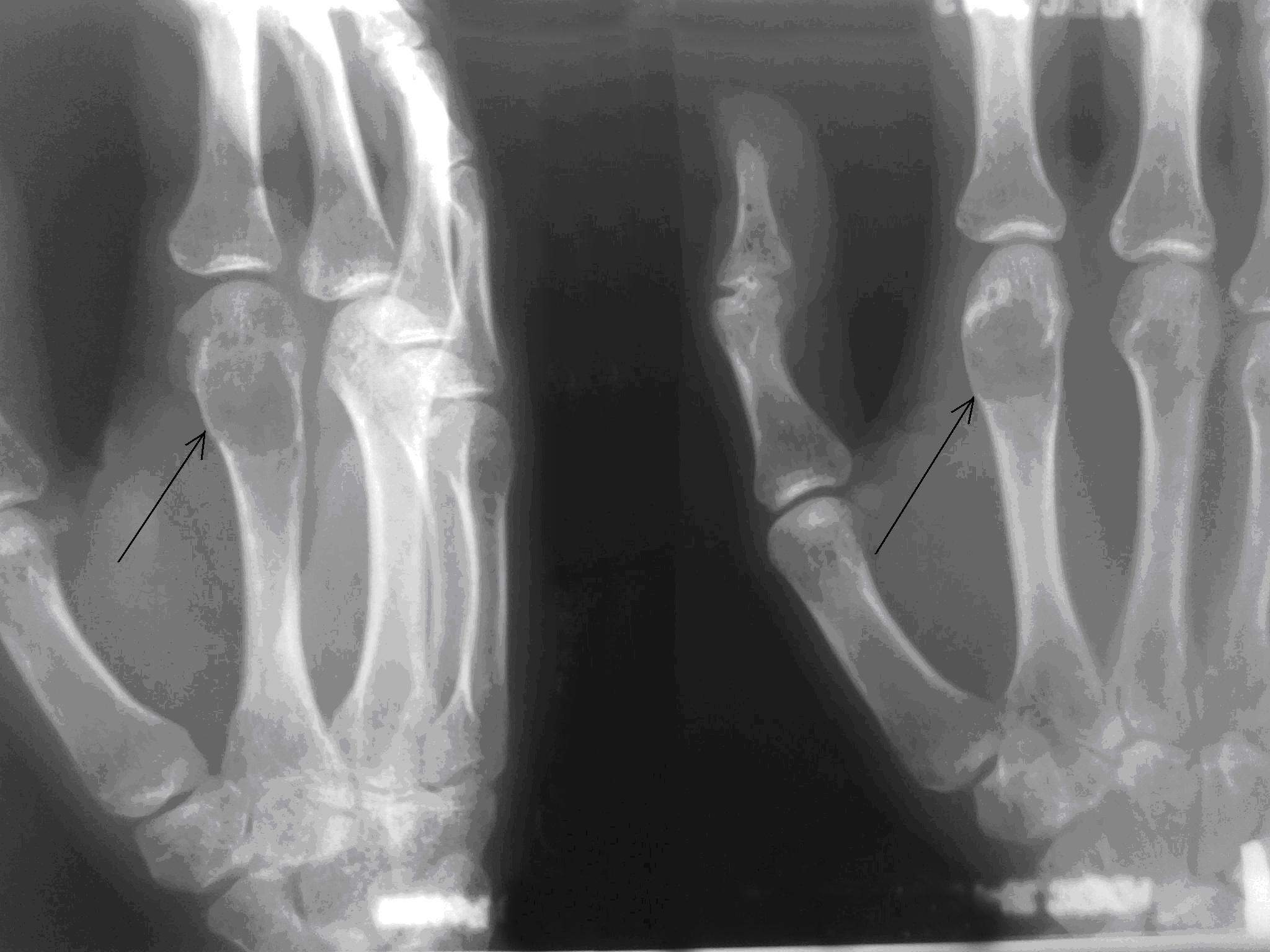 Рис. 1. а) Рентгенограмма левой кисти в прямой и боковой проекциях больной Д. до оперативного лечения (стрелками указана энхондрома II пястной кости).