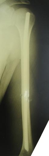 Рис. 1. Рентгенограммы больного В., 21 года, прооперированного стержнями прямоугольного поперечного сечения по поводу закрытого неосложненного косого перелома средней трети левой плечевой кости: а – после травмы, б – после остеосинтеза, в – сращение.
