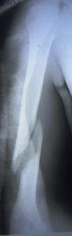 Рис. 2. Рентгенограммы больного Е., 20 лет, прооперированного стержнем с блокированием винтами по поводу закрытого неосложненного винтообразного перелома средней трети правой плечевой кости: а – после травмы, б – после остеосинтеза, в – сращение.