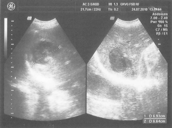 Рис. 1. Больной К., 21 г. УЗ картина абсцесса правой доли печени на фоне деструктивной пневмонии и сепсиса.