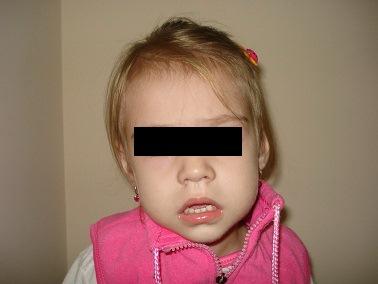 Рис. 1. Ребенок 3 года. Вертикальная резцовая дизокклюзия, нарушение носового дыхания (вредная привычка - сосание соски-пустышки).