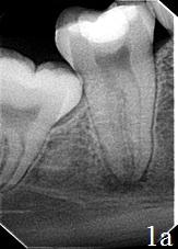 Рис. 1. Радиовизиограммы пациента контрольной группы 47 зуба (до лечения и спустя двенадцать месяцев); а – четко виден участок периапикального разрежения с нечеткими контурами; замыкательная пластинка лунки 47 зуба – разрушена; б - визуализируется уменьшение размеров околоверхушечного костного деструктивного очага на 1/3, формирование костно-трабекулярной структуры, наблюдается линейное увеличение плотности рисунка, сохраняются нечеткие контуры очага.