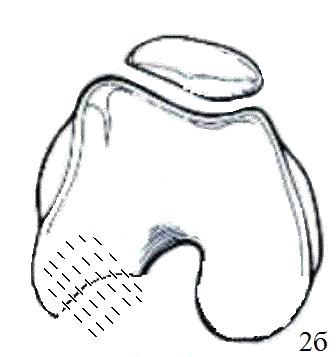 Рис. 2. Схематичное изображение подшивания «Chondro-Gide»: б - внутрисуставная остеоперфорация.