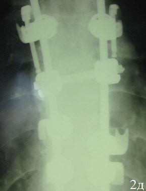 Рис. 2: а, б, в - рентгенограммы и ЯМРТ при госпитализации; г, д - после операции.
