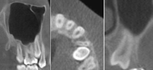 Рис. 1б. КЛКТ (мультипланарные реконструкции). По данным представленных кросс-секций и мультипланарных реконструкций зуб находиться на стадии несформированной верхушки, переодонтальная щель прослеживается не на всем протяжении (анкилоз зуба 1.5), также представляется возможным оценить отношение до небной кортикальной пластинки и до вестибулярной кортикальной пластинки.
