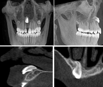 Рис. 2. КЛКТ (мультипланарные реконструкции). Зуб 1.1 уменьшен в размере, имеет изогнутый корень, зуб полностью сформирован, ростковая зона не определяется. Коронковая часть зуба располагается за пределами альвеолярного отростка (в толще мягких тканях), задняя поверхность зуба прилежит в верхней трети к вестибулярной кортикальной пластинки. Изогнутая апикальная часть зуба сращена с нижней стенкой полости носа справа. Периодонтальная щель прослеживается не на всем протяжении (анкилоз).