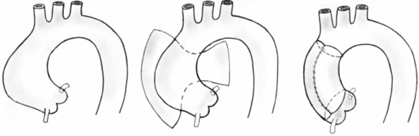 Рис. 4. Схема модифицированной техники окутывания расширенной восходящей аорты.