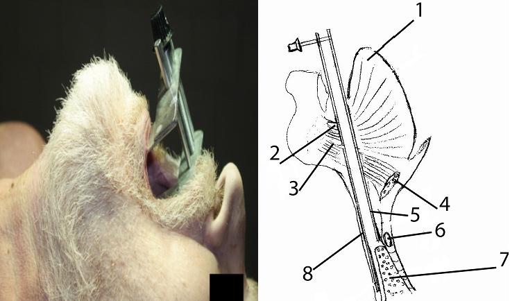 Рис. 6. Сагиттальный срез дна полости рта, гортани и глотки и положение ранорасширителя непосредственно перед началом хирургических манипуляций на щитовидной железе, после установки и разведения браншей ранорасширителя – эксперимент на анатомическом объекте (1 – язык, 2 – подбородочно-язычная мышца, 3 – подбородочно-подъязычная мышца, 4 – подъязычная кость, 5 – короткая бранша, 6 – щитовидный хрящ, 7 – щитовидная железа, 8– длинная бранша).