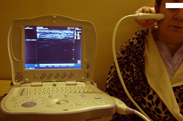 Рис. 1. Ультразвуковое сканирование кожи пациентки А.,55 лет аппаратом LOGIC 1200, В-режим.