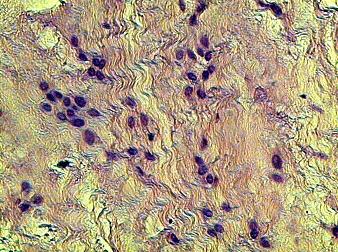 Рис. 4. Возрастание числа округлых клеток и различные типы коллагеновых волокон вблизи места повреждения мениска. Г-Э 10х40.