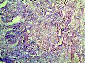 Рис. 6. Единичные округлые клеток полиморфизм коллагеновых волокон аваскуляризированной зоны мениска вблизи места повреждения. Г-Э 10х40.