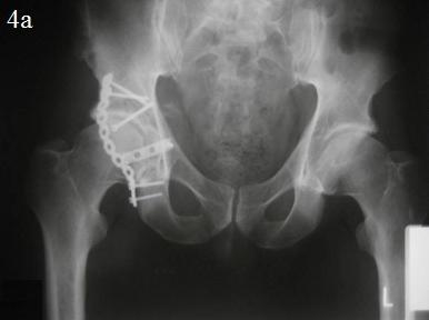 Рис. 4. Послеоперационные рентгенограммы костей таза: а – обзорная рентгенограмма, б – косая подвздошная проекция, в – косая запирательная проекция.