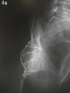 Рис. 4. Послеоперационные рентгенограммы костей таза: а – обзорная рентгенограмма, б – косая подвздошная проекция, в – косая запирательная проекция.