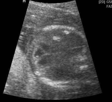Рис. 1. Эхограмма. Поперечное сканирование. Беременность 21 неделя. Кальцификаты в печени у плода.