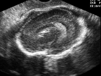 Рис. 2. Эхограмма. Парасагиттальное сканирование. Беременность 29 нед. Нейроинфекция у плода (цитомегаловирус). Гиперэхогенный кальцификат в области головки хвостатого ядра.