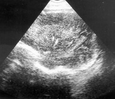 Рис. 3. Эхограмма. Парасагиттальное сканирование. Минерализационная васкулопатия у плода 40 недель гестации.