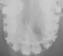 Рис. 2. Внутриротовая окклюзионная рентгенография верхней челюсти «вприкус». Состояние после костной пластики через 6 месяцев