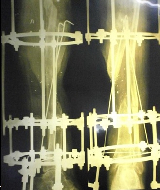 Рис. 2. Рентгенография левой голени в 2-х проекциях пациента при поступлении