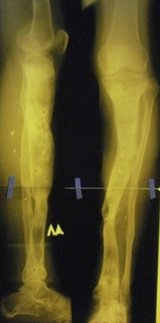 Рис. 8. Рентгенография левой голени в 2-х проекциях в конце лечения
