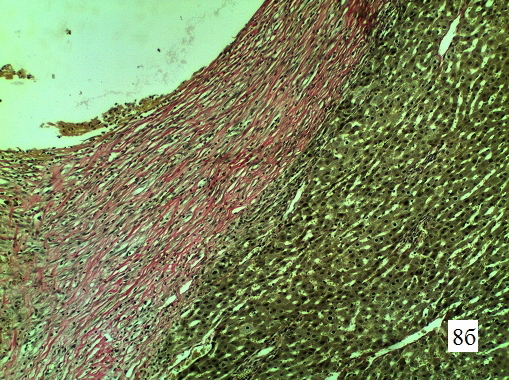 Рис. 8б. Гистологическая структура парадренажной зоны печени крысы на 14-е сутки. Микрофотография стенки свищевого хода, увеличение 1х300, окраска по Ван-Гизон на коллагеновые волокна. Коллагеновые волокна (розовое окрашивание) формируют плотные пучки на всю толщу стенки, местами образуя гомогенные гиалинизированные пучки.