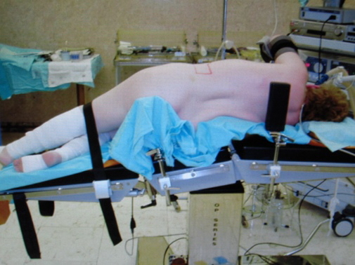 Рис. 1. Положение больного на операционном столе для люмбоскопического доступа.
