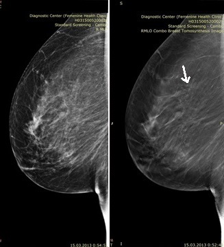 Рис. 2. Стандартная цифровая маммограмма (слева) в боковой проекции и томограмма (справа).