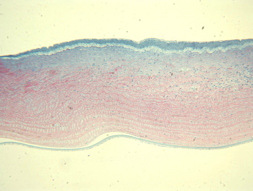 Рис. 3. Гиперплазия эпителия с правильной дифференцировкой. В центральной зоне незрелая соединительная ткань. На периферии очага воспалительный инфильтрат с новообразованными сосудами. Ув. x125.