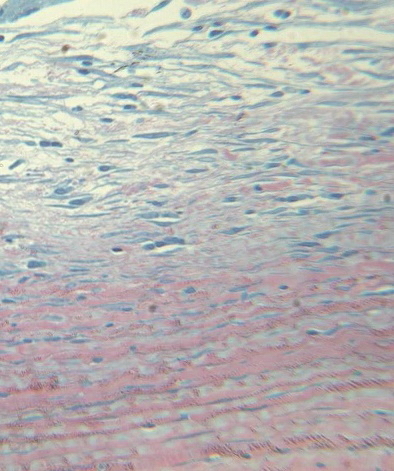 Рис. 7. Гиперцеллюлярность поверхностных слоев стромы за счет фибробластоподобных клеток. Фибробласты параллельны поверхности роговицы. Ув. x250.