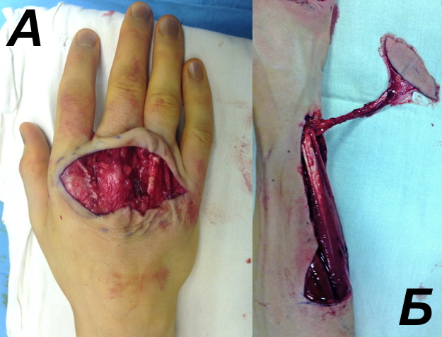 Рис. 2. Пациент Г. 31 год: а - вид кисти после удаления олеогранулёмы; б - выделенный задний межкостный лоскут предплечья на сосудистой ножке.