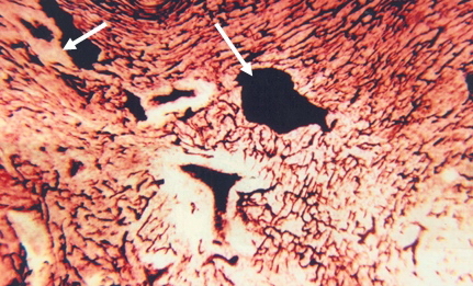 Рис. 3. Ребенок Д., 5 дней (протокол № 493), на гистологическом срезе видна деформированная капиллярная сеть. Стрелками отмечены сосуды Вьессена-Тебезия (наливка туш-желатиновой массы из устьев сосудов Вьессена-Тебезия, с последующей окраской препарата гемактосилин – эозин, увеличение 10х8).