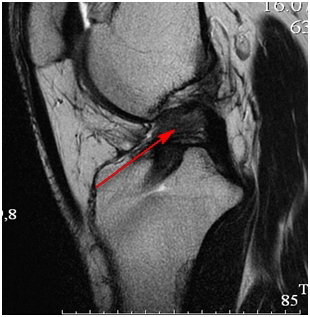 Рис. 2. МРТ коленного сустава. Видно, что имплантат (показан стрелкой) имеет «размытые» контуры, отсутствует его «натяжение».