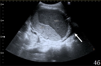 Рис. 4. Эхограммы брюшной полости на которых определяется: а – скопление неоднородной жидкости правом поддиафрагмальном пространстве (1); б – скопление неоднородной жидкости в левом поддиафрагмальном пространстве (abs), селезенка (lien), реактивный гидроторакс (указано стрелкой).