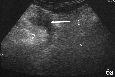 Рис. 6. Эхограммы брюшной полости на которых изображены: а, б – наличие неоднородной жидкости (1) в составе перифокального инфильтрата (2).