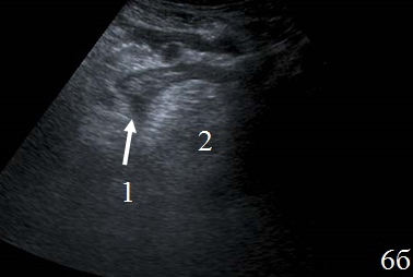 Рис. 6. Эхограммы брюшной полости на которых изображены: а, б – наличие неоднородной жидкости (1) в составе перифокального инфильтрата (2).