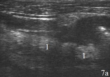 Рис. 7. Эхограммы брюшной полости на которых визуализируются: а, б – наличие перифокального инфильтрата (1).