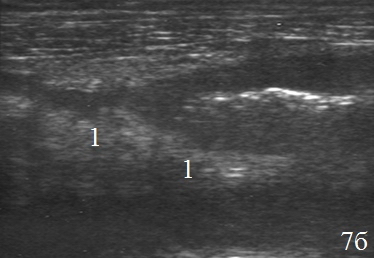 Рис. 7. Эхограммы брюшной полости на которых визуализируются: а, б – наличие перифокального инфильтрата (1).