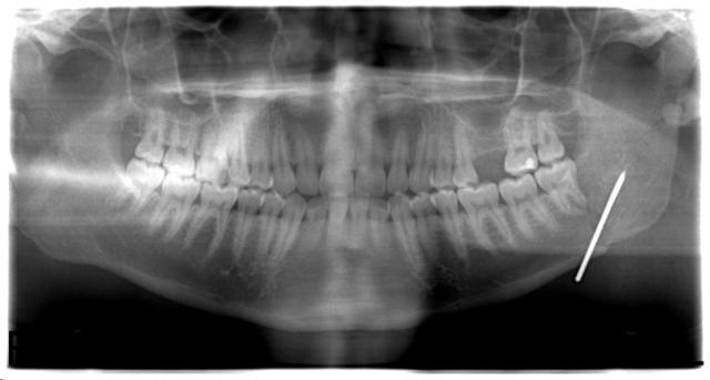 Рис. 8. Ортопантомограмма нижней челюсти после операции
