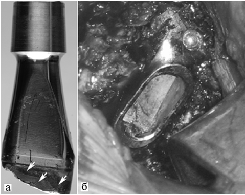 Рис. 1. Перелом модульной шейки вследствие фреттинг-коррозии в месте сочленения с бедренным компонентом, данные Wright C.G. [8].