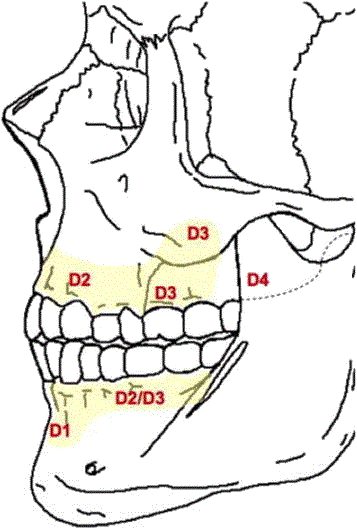 Рис. 3. Типы костной ткани на верхней и нижней челюсти в соответствии с классификацией Misch.