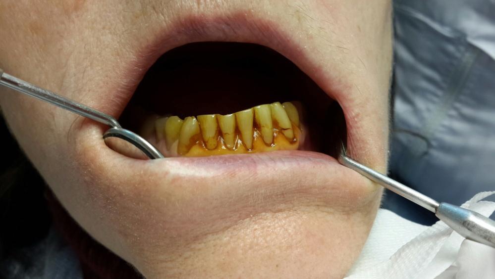 Рис. 1а. Гигиеническое состояние полости рта до использования зубных паст с нейтрализаторами сахарных кислот.