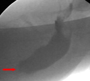 Рис. 6. Отсутствие опорожнения при рентгенологической видеодефекоскопии (стрелка).