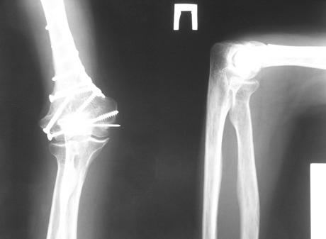 Рис. 3. Рентгенограммы левого локтевого сустава, 1 год и 6 месяцев после операции.