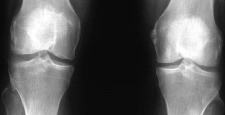 Рис. 1. Рентгенограмма коленных суставов. ОА, стадия 1. Суставная щель не сужена. Небольшие остеофиты на краях суставных поверхностей бедренной, большеберцовой кости и межмыщелковых возвышений.