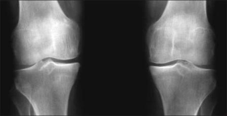 Рис. 2. Рентгенограмма коленных суставов. ОА, стадия 2. Сужены щели суставов. Небольшие остеофиты на медиальных углах суставных поверхностей бедренной и большеберцовой костей.