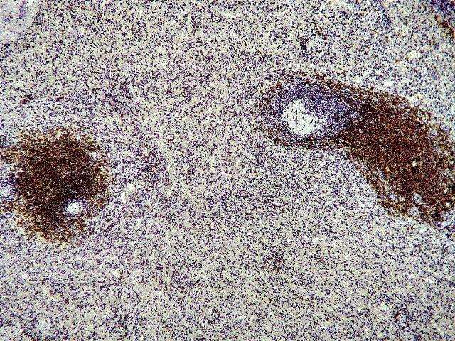 Рис. 1. Селезенка (больной М., 27 лет, диагноз: апластическая анемия): распределение В-клеточных элементов (CD20+) в белой и красной пульпе. Окраска CD20, Clone L26, «Dako», ИПМ. Ок. х10, об. х10.