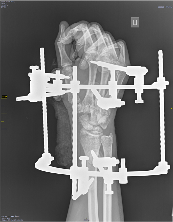 Рис. 2. Рентгенография правой кисти пациента после операции.	