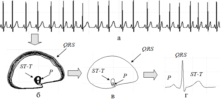Рис. 1. Последовательность этапов обработки ЭКГ: исходная ЭКГ (а); ее фазовая траектория (б); усредненная фазовая траектория (в); эталонный цикл ЭКГ во временной области (г).