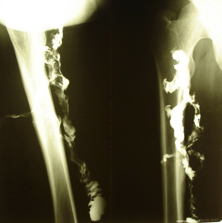 Рис. 2. Напряженная фистулография правого бедра пациентки Ю., 23 лет. Контрастирована большая сложной формы полость в мягких тканях, видна связь контрастированной полости с костными структурами