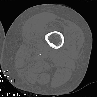 Рис. 4. Компьютерная томограмма левого бедра пациентки П., 45 лет с хроническим посттравматическим остеомиелитом. Выявлен мелкий секвестр в мягких тканях не визуализирующийся на рентгенограммах
